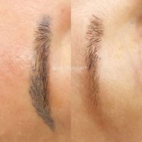 Permanent MakeUp Removal in Schwerte